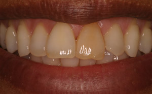 Dark colored teeth before whitening