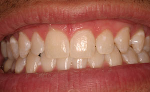 Gorgeous teeth after whitening