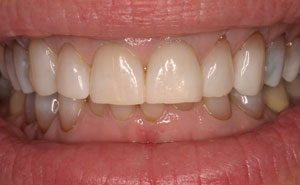 Brilliant picture-perfect smile after teeth whitening