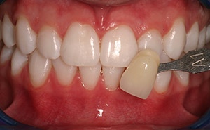 Brilliant smile after professional whitening