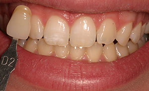 Discolored teeth before professional whitening