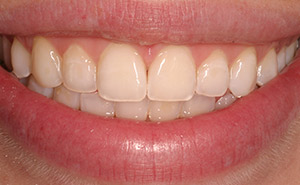 Brilliant white teeth before professional whitening