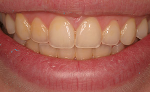 Yellow teeth before professional whitening