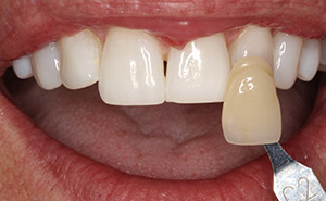Brilliant top teeth after whitening