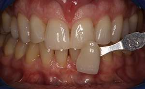 Discolored top teeth before whitening