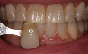 Dental discoloration before teeth whitening